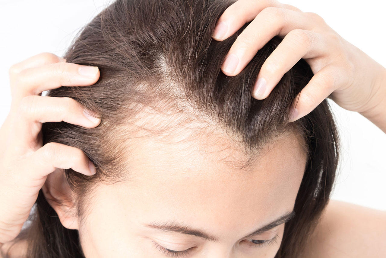 can testosterone injections cause hair loss